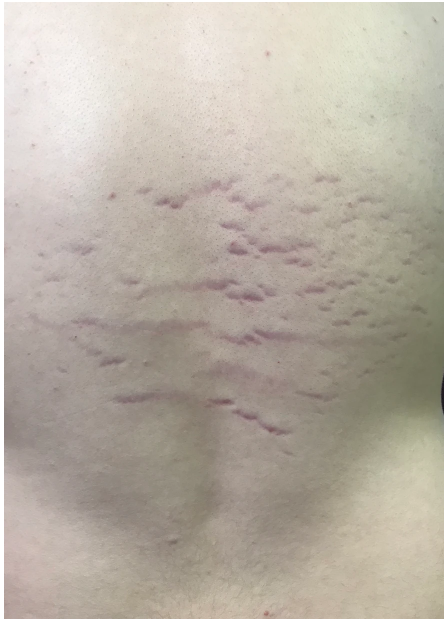 Bartonella tracks on back